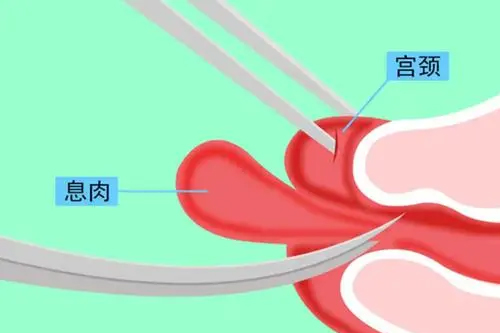 哪些因素会造成宫颈息肉复发